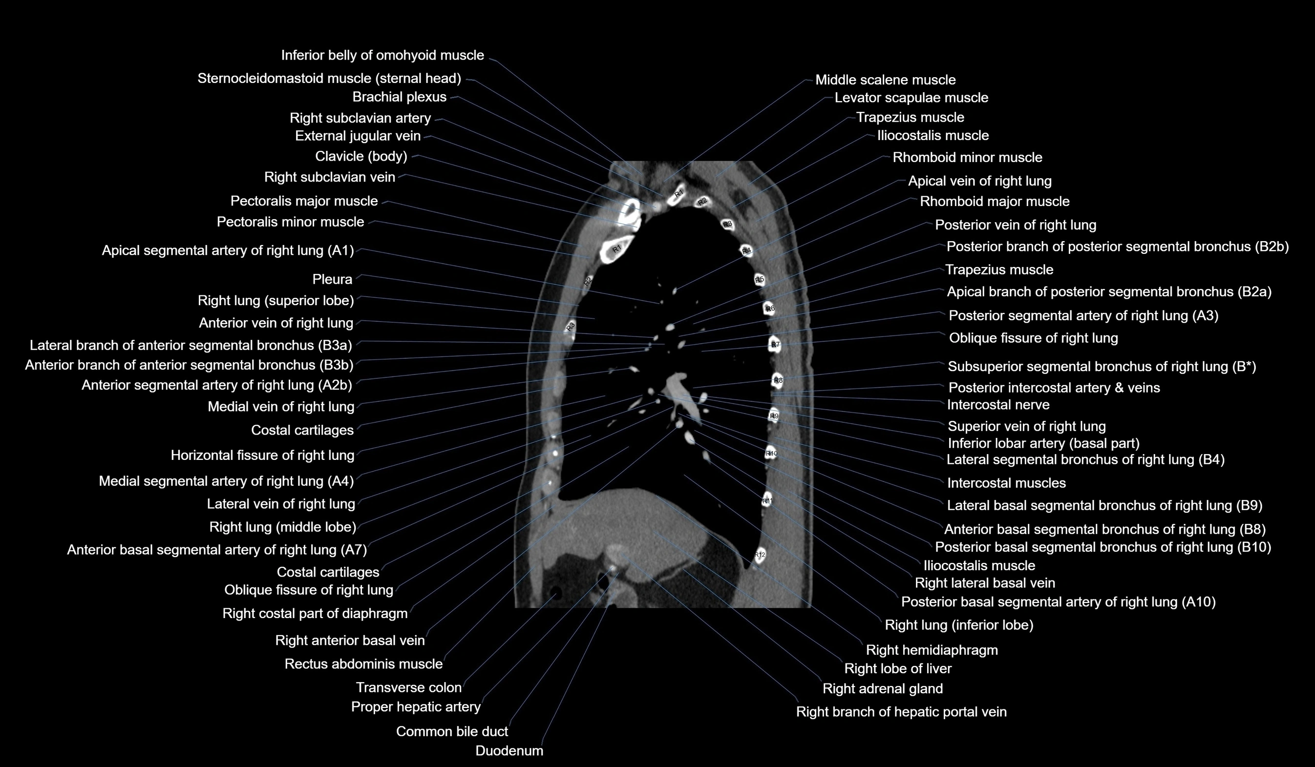 CT chest (thorax) soft tissue window labelled sagittal cross sectional anatomy radiology image-00053.webp